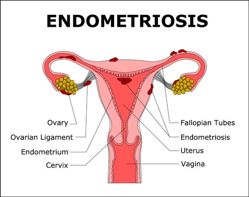 This is an image of Endometriosis Chinese Medicine Sunshine Coast